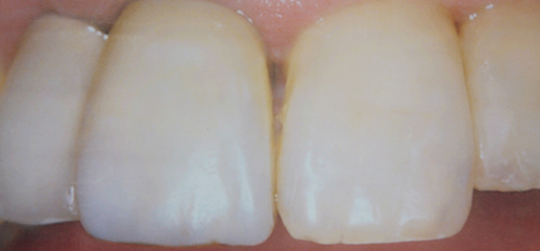 Toothwhitening1